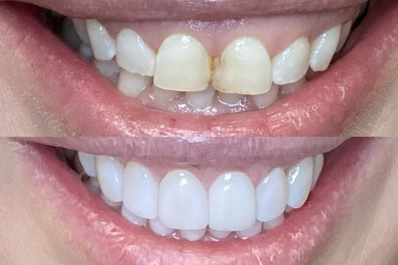 Smile Makeover in Skokie, Chicagoland