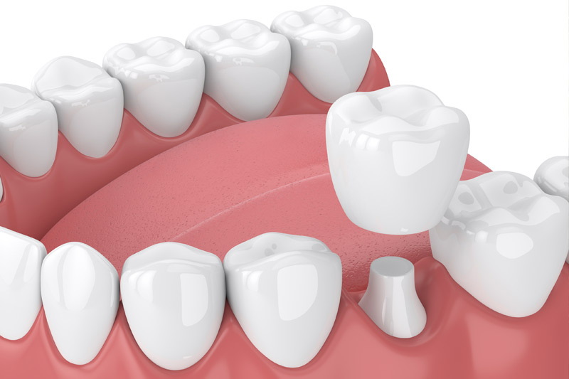 Dental Crowns in Skokie, Chicagoland