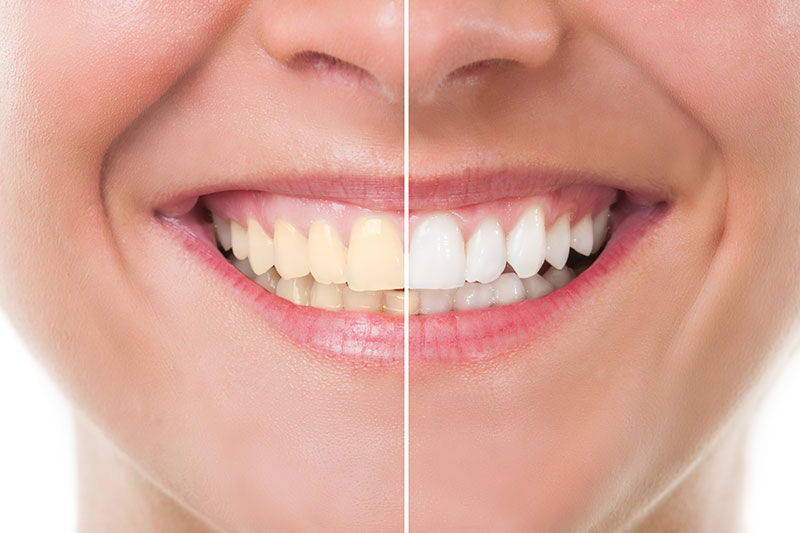 Teeth Whitening in Skokie, Chicagoland