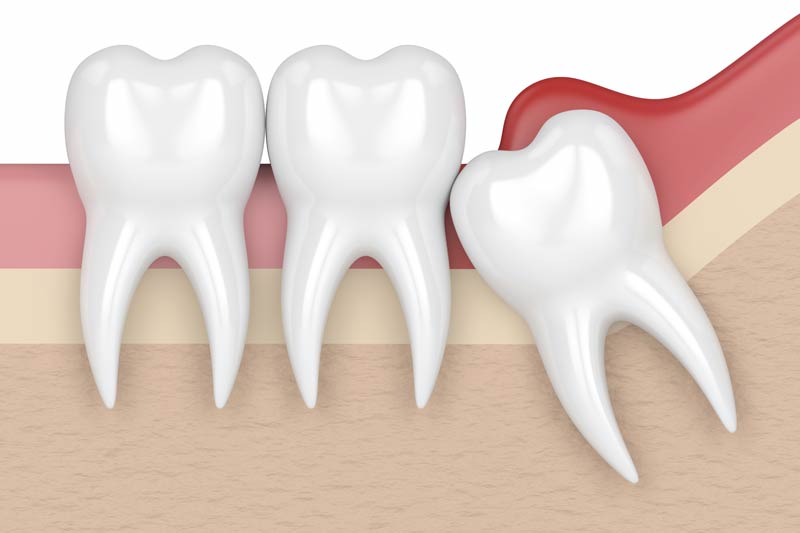 Wisdom Tooth Removal in Skokie, Chicagoland